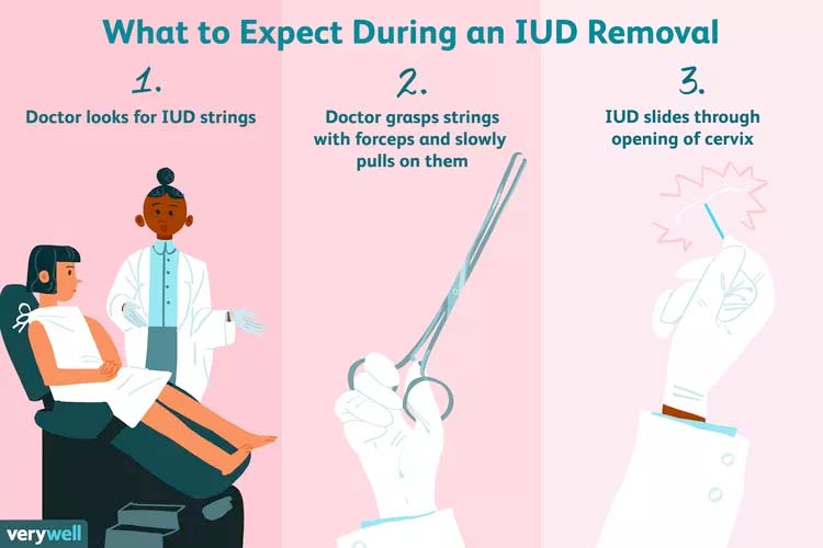 IUD Removal