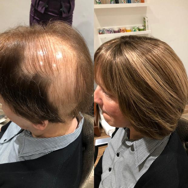 Alopecia sufferer from Co Antrim hails boost to her self-confidence after undergoing revolutionary new hair loss treatment