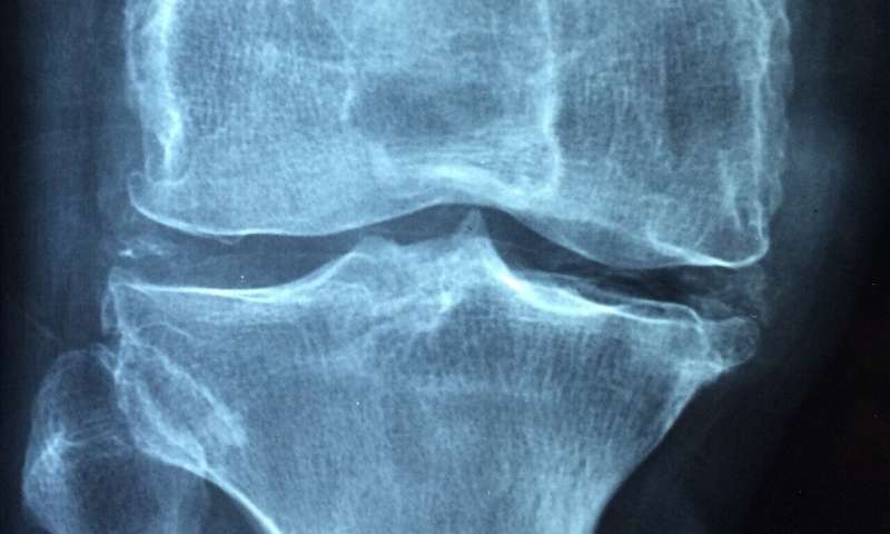 Researchers develop nano-based technology to fight osteoporosis