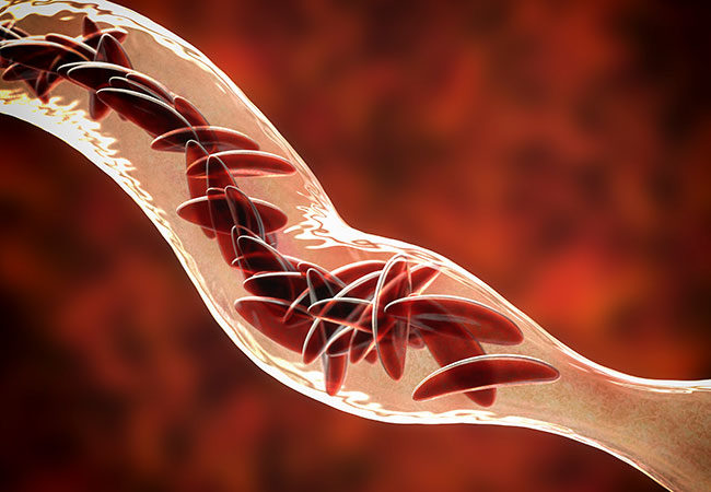 Sickle Cell Disease Market Research Report 2022-2032: Size, Share, Top Key Players and Forecast