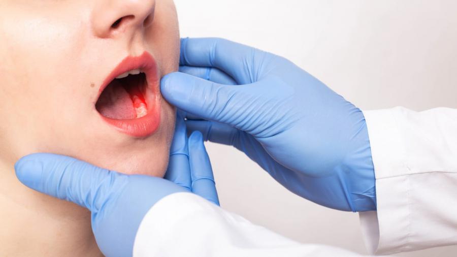 Oral Cancer Treatment Market Size Worth US$ 2.5 Billion by 2028 | CAGR of 5.50%