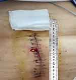 A Case Report of Wound Infection Caused by Mycobacterium porcinum